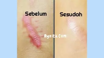 Cara Menghilangkan Bekas Jahitan di Kening