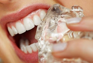 Nên ăn gì sau khi trám răng?