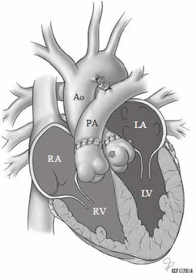 Arterial switch surgery