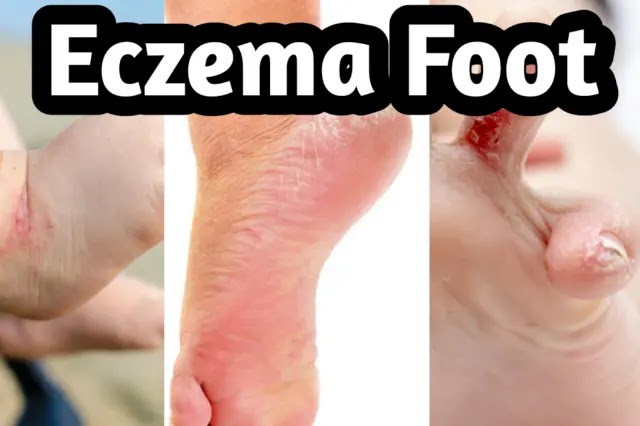 Foot eczema: causes and treatment eczema foot