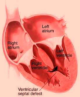 Vsd Management VSD | MANAGEMENT OF HEART DISEASE