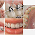 Niềng răng chỉnh nha có ưu điểm gì?
