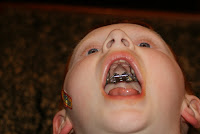 The Never Ending Adventures of Colin and His Palate Expander!: Before