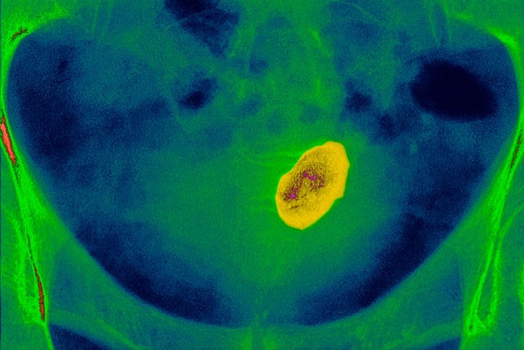 ماذا تأكل لمنع حصى الكلى