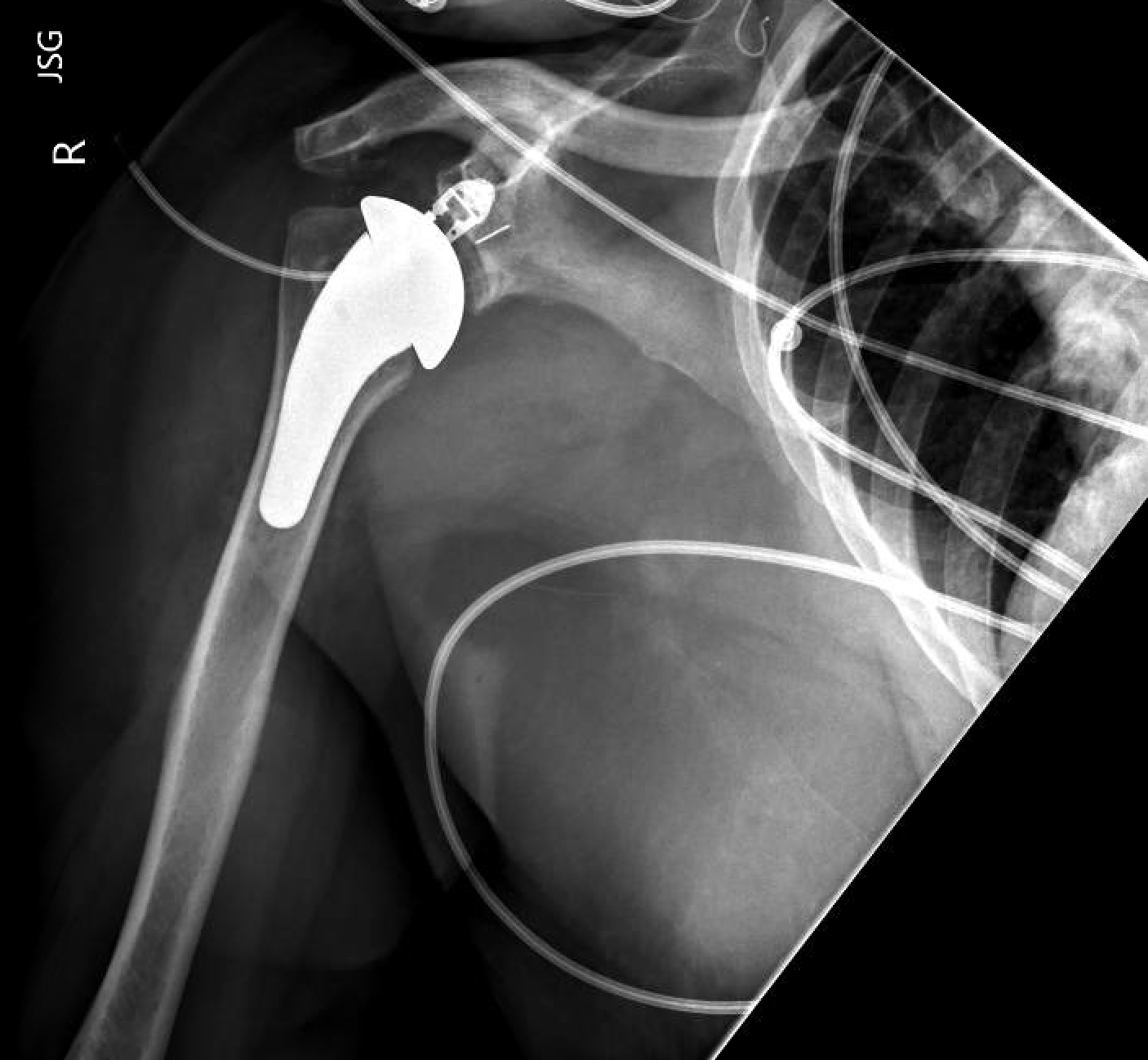 Shoulder and Elbow Surgery Obesity and total shoulder replacement