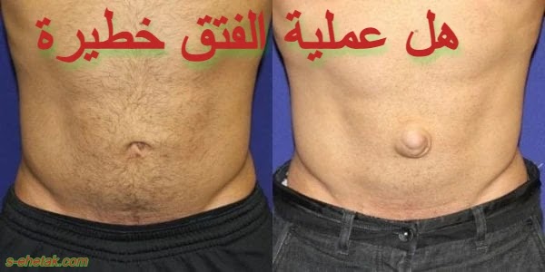 هل عملية الفتق خطيرة