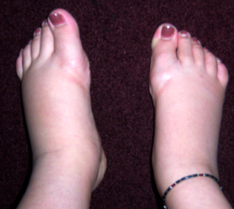 Swelling Ankles | Cankle Exercises: Cankles Definition