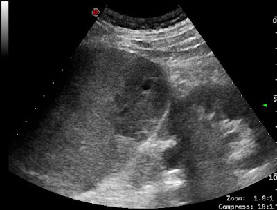 Spleen infarction and hepatosplenic manifestation of lyphoma