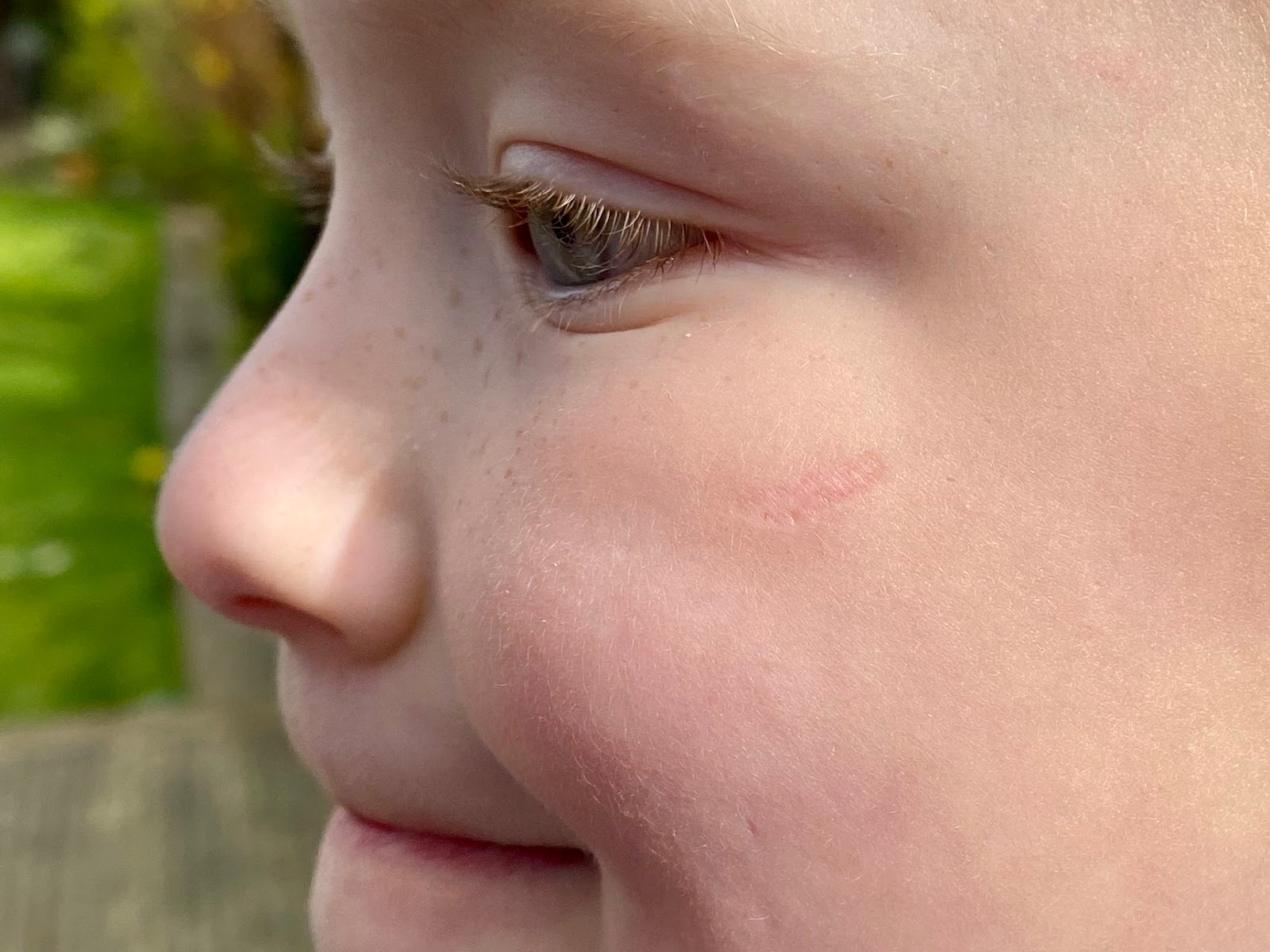 Child Scar On Face Before And After Debora Milke