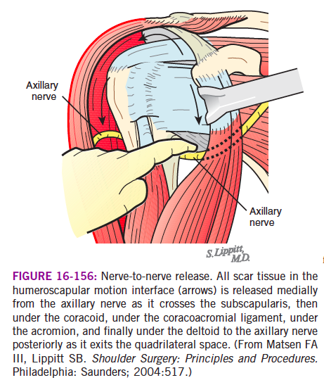Shoulder Arthritis Rotator Cuff Tears Causes Of