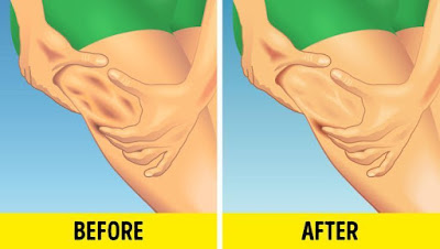 This Anti-Cellulite Remedy Is The First One That Actually Works