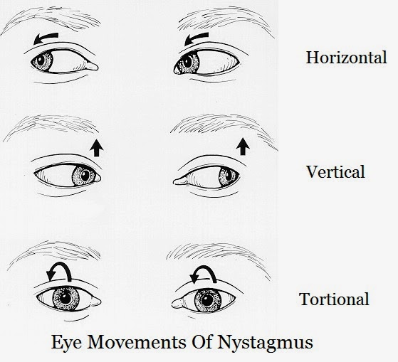 Improve vision naturally with neurovision technology Involuntary Movement of the Nystagmus Eyes