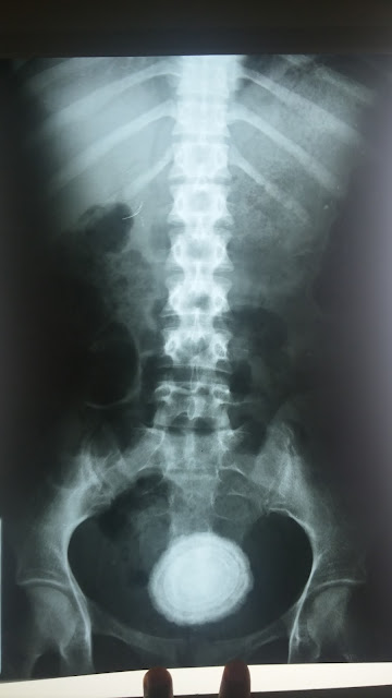 A large stone in urinary bladder A large stone in urinary bladder courtesy of Dr. Adil Ramzan