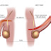 Erectile dysfunction | causes | signs | treatment