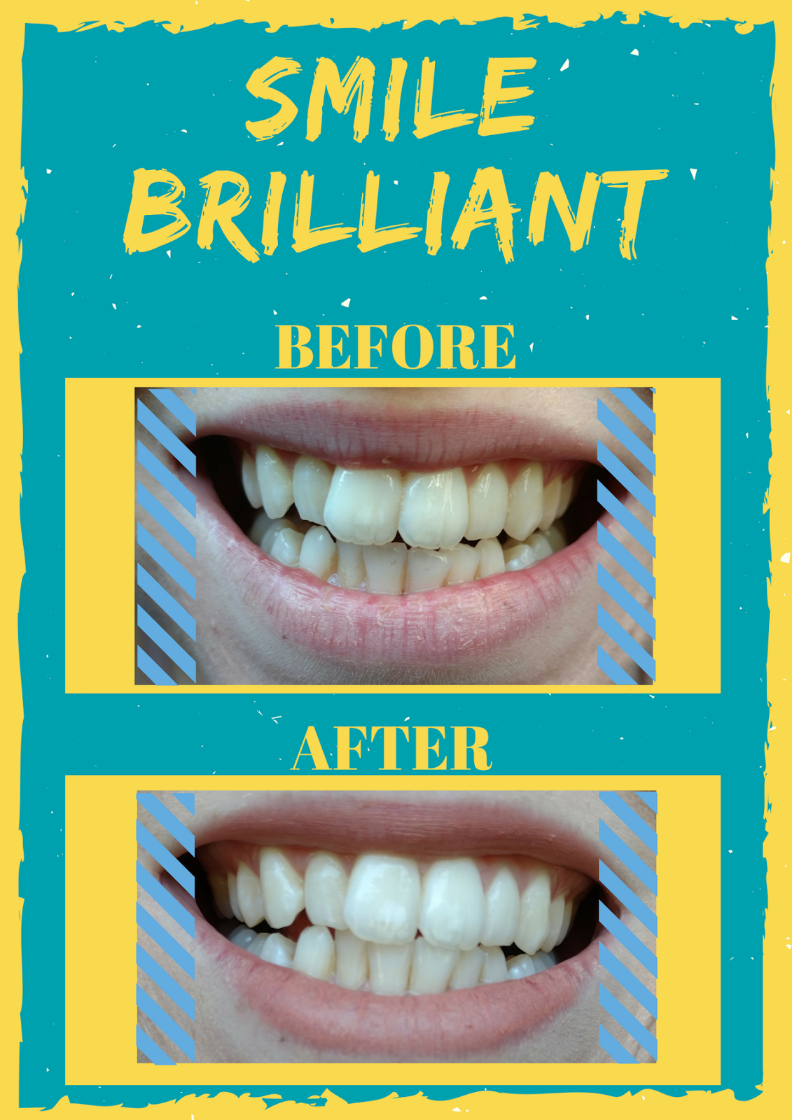 At Home Teeth Whitening For Tea Drinkers Affordable by Amanda