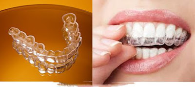 Tẩy trắng răng bằng máng có đảm bảo an toàn? 2