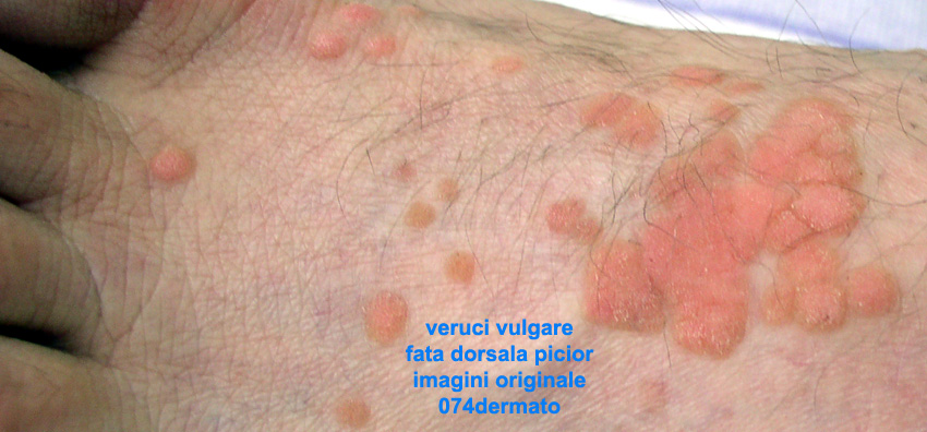 sunt verucile extrudate