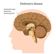 Cara Menyembuhkan Parkinson
