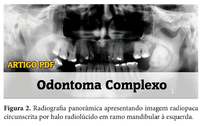 CASO CLÍNICO: Odontoma Complexo de grande proporção em ramo mandibular: relato de caso