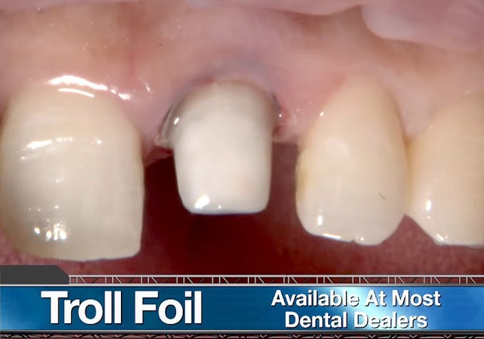 PROSTHODONTICS: Stump Shade Showdown - Dr. Muresan