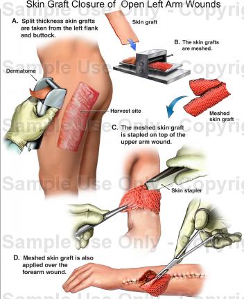 Skin Grafting Technique (Foot) Full Procedure - YouTube