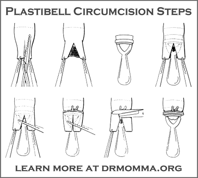 Know Your Procedure - Circumcision Procedure Step-by Step