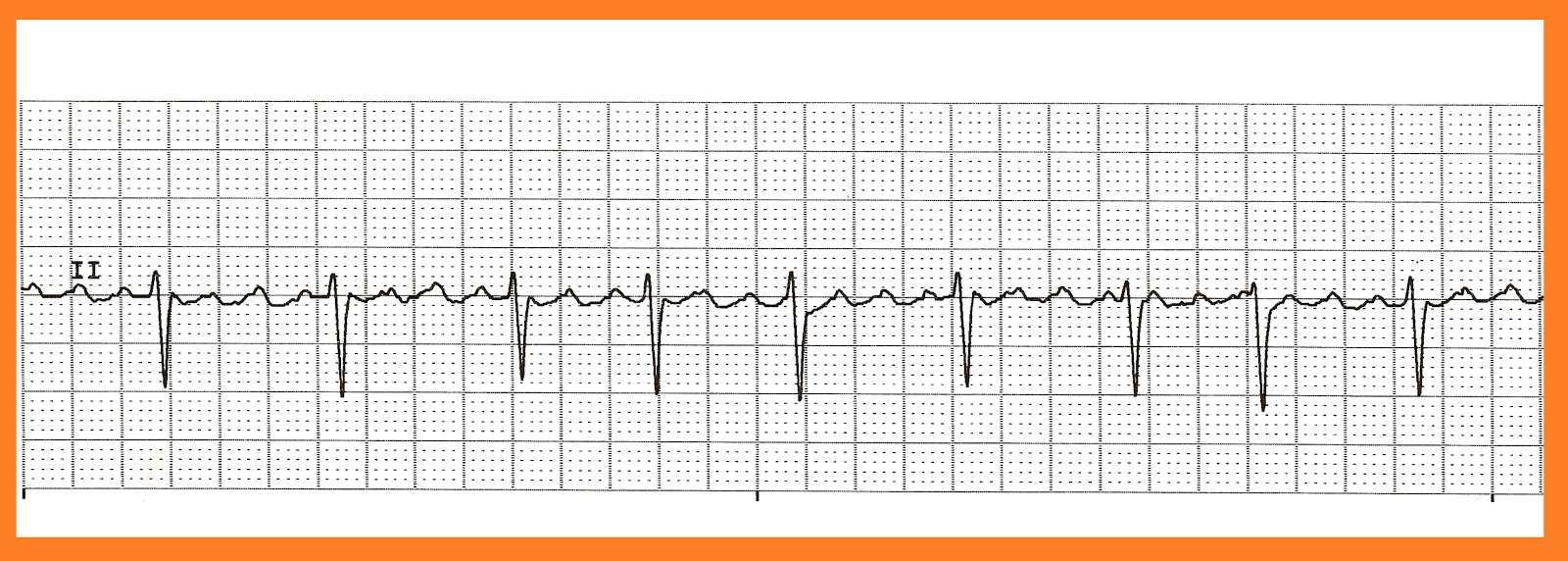 Flutter With Rvr Rate 160s Example A flutter with rvr treatment - dropbutler