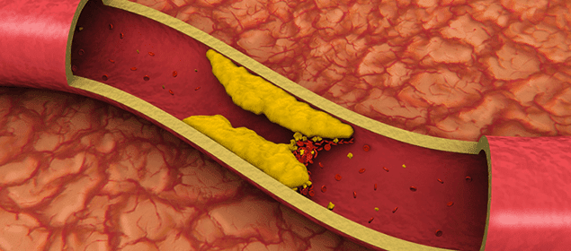 cómo bajar el colesterol