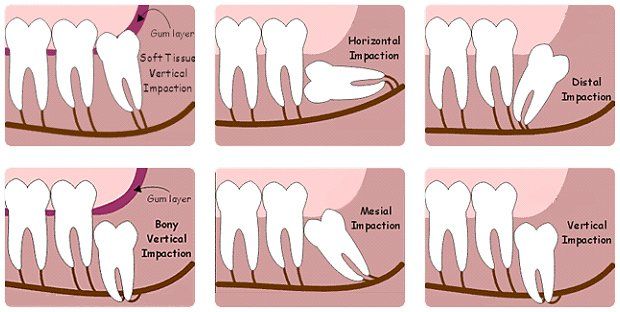 Gigi Bungsu Tumbuh Normal - Perumperindo.co.id