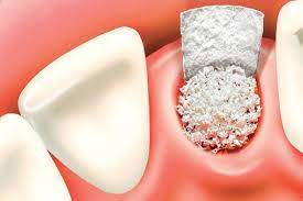 Dental Membrane and Bone Graft Substitute
