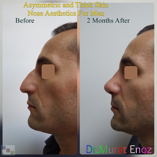 Rhinoplasty for male in Istanbul - Men's nose aesthetic in Turkey - Male rhinoplasty
