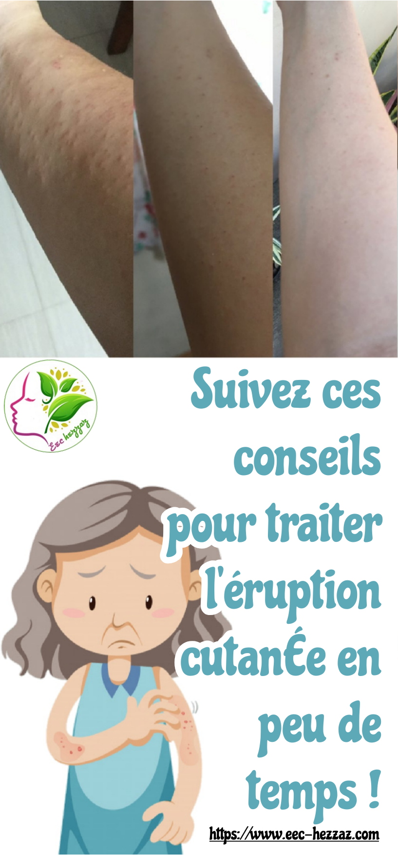 Suivez ces conseils pour traiter l’éruption cutanée en peu de temps !