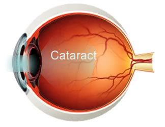 Why Sunglasses are Important After Cataract Surgery