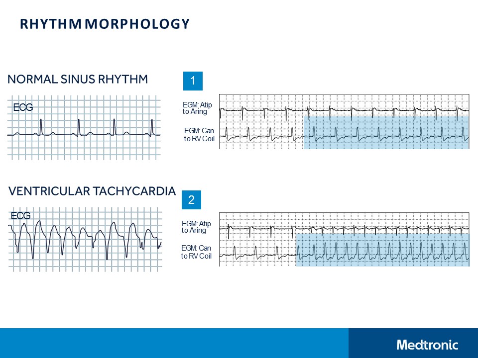 CVT Mohd Farid: Concept Of ICD Technology-SVT Discrimination Algorithms ...