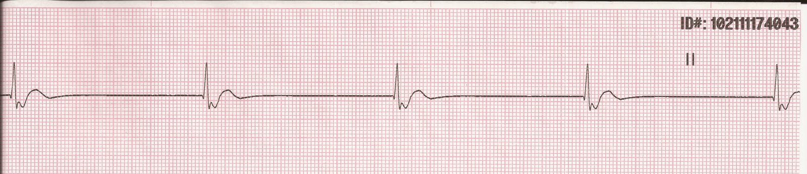 junctional escape rhythm junctional escape rhythm