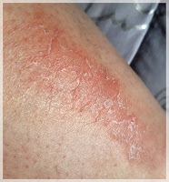 psoriasis en plaque mon psoriasis en plaque sur les jambes