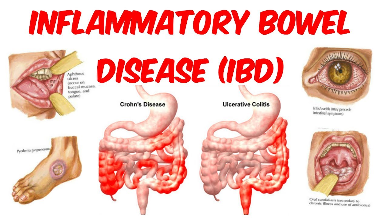 IBS IBD ibs-ibd