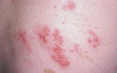 herpes skin rashes #11