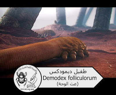 طفيل ديمودكس Demodex folliculorum (عث الوجه)