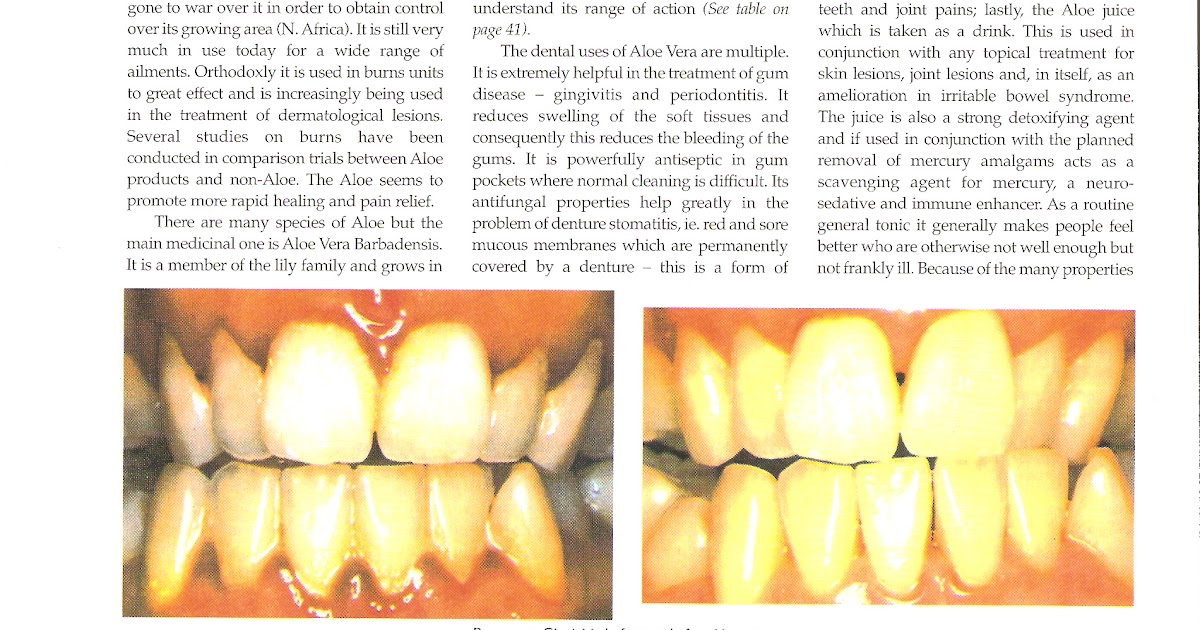 Natural Antifungal Treatment Natural Antifungal Treatment