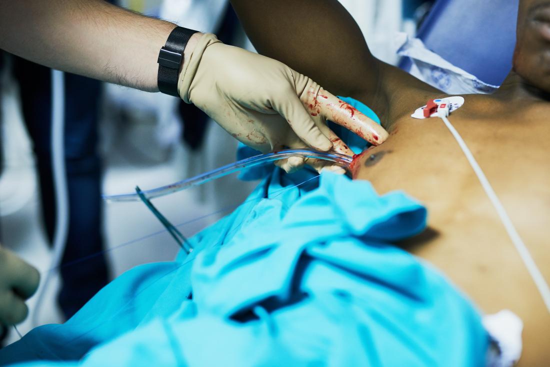 EmergencyMedJC Effectiveness And Safety Of Small bore Chest Tubes 20 emergencymedjc-effectiveness-and-safety-of-small-bore-chest-tubes-20