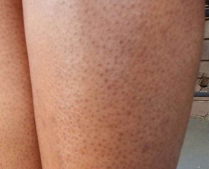 Fashion Beauty And Lifestyle Got Strawberry Legs This Is How To