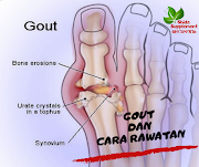 Gout Dan Cara Rawatan 