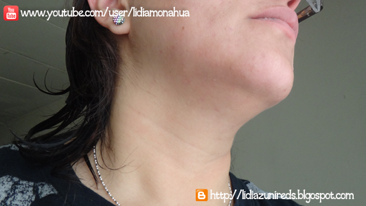 tratamiento que uso para el ácne