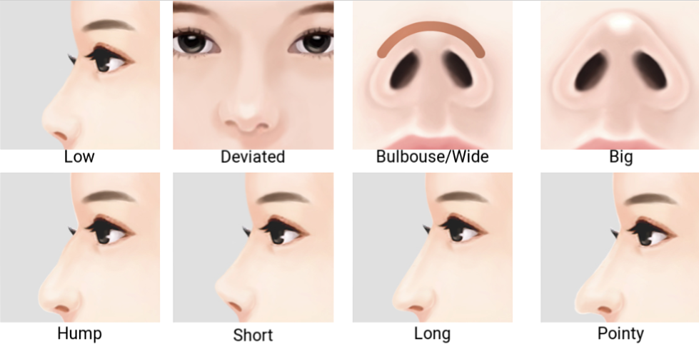 Bulbous Nose / Wide alar base (nostrils) - Short (Upturned) nose - often ca...