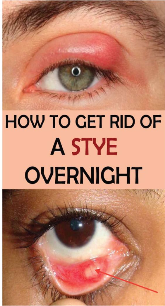 How To Get Rid Of A Stye Overnight 34 Home Remedies Healthy Greens how-to-get-rid-of-a-stye-overnight-34-home-remedies-healthy-greens