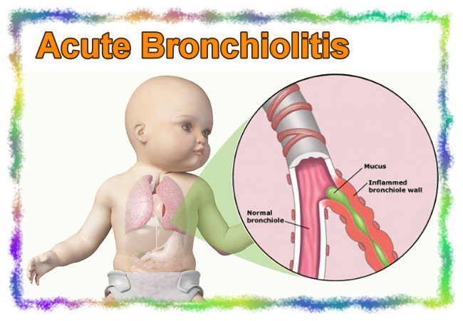 хронический бронхит симптомы. клинические симптомы катарального и гнойного бронхита. хронический бронхит исход. доп исследования при хобл. основной симптом необструктивного бронхита.