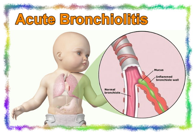 Бронхиты у грудных детей. Гнойно обструктивный бронхит. Гнойный бронхит симптомы.