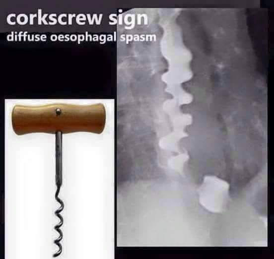 Study Medical Photos Diffuse esophageal spasm (DES)