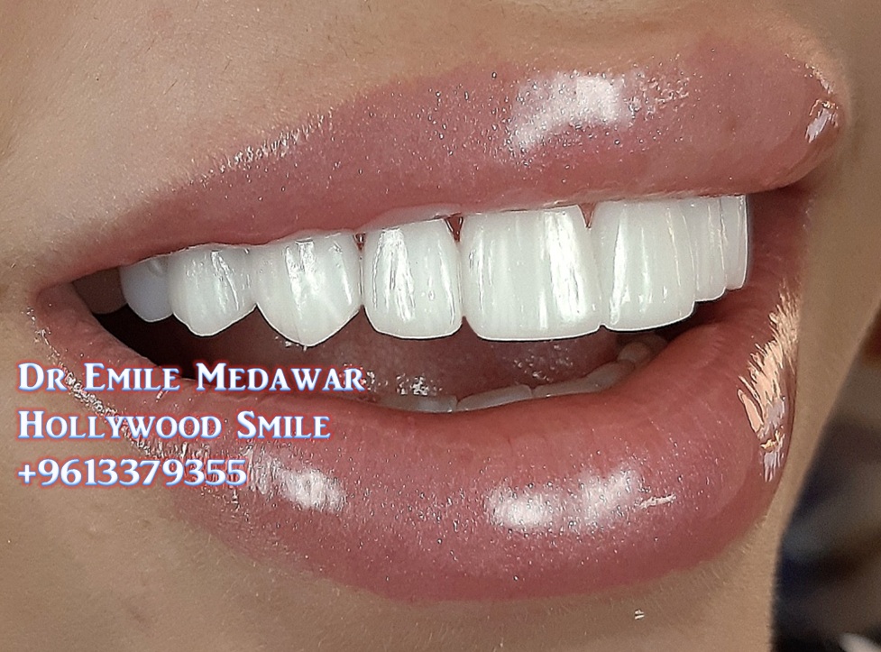EMax Veneer, Dr Emile Medawar, 00 961 3 379355 Porcelain Veneers, E
